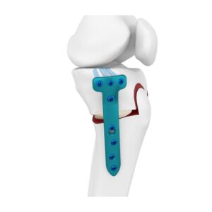 Placa Bloqueada De Osteotomía Tibial Proximal Medial