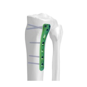Placa Bloqueada Tibial Proximal Posterior Medial