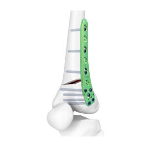 Placa De Bloqueo Para Osteotomía Femoral Lateral Distal