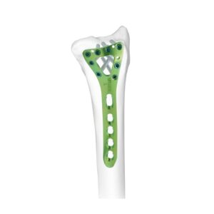 Placa Bloqueada Delta Radial Distal Dorsal
