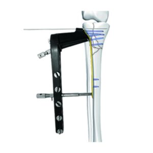Placa De Bloqueo Del Contrafuerte De La Cabeza Tibial Lateral Ⅱ