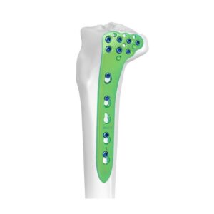 Placa Bloqueada Tibial Proximal Lateral