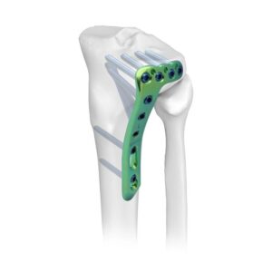 Placa Bloqueada Tibial Proximal Lateral Ⅱ