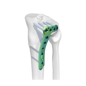 Placa De Bloqueo En L Para Tibia Lateral Proximal
