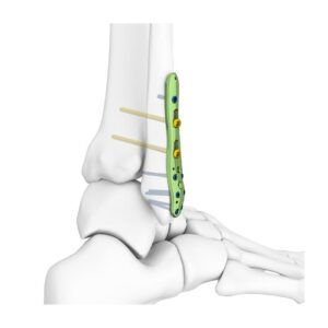 Placa Bloqueada Para Peroné Distal Lateral