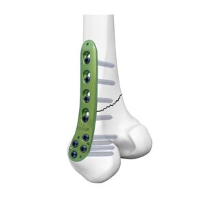Placa Bloqueada Femoral Distal Medial Sub-Condilar