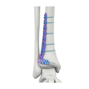 Placa De Bloqueo Tibial Lateral Anterior Distal VAL