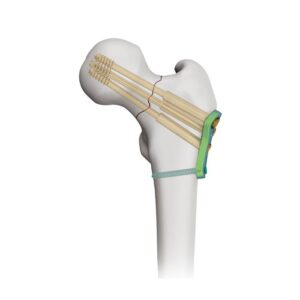 Placa Bloqueada Femoral Proximal Para Tornillo Bloqueado Canulado 7.3mm