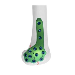 Placa Bloqueada Femoral Distal Medial Condilar