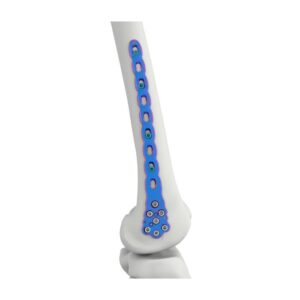 Placa De Bloqueo Femoral Distal VAL