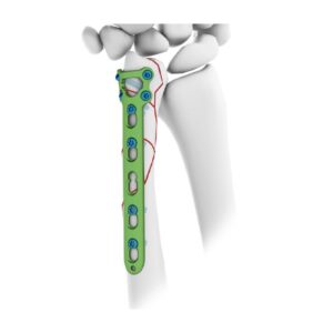 Placa De Bloqueo Cubital Distal