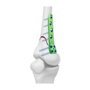 Placa De Bloqueo Para Osteotomía Femoral Medial Distal