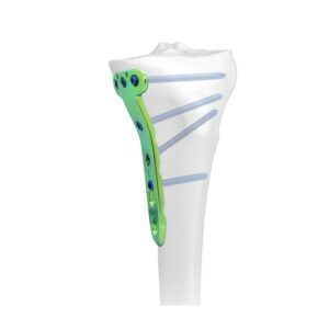 Placa Bloqueada En T Tibial Proximal Medial, Orif-Dual