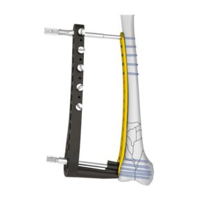 Placa Bloqueada Femoral Distal Ⅱ