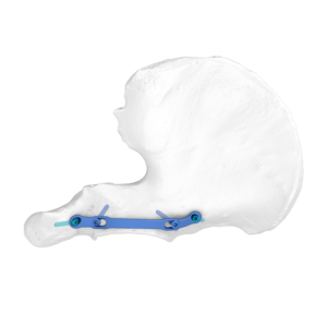 Placa De Bloqueo Anatómica De Pared Posterior FAPSistema de Placa Acetabular Flexible (FAP) con diseño flexible, universal y anatómico, se adapta excelentemente a todo tipo de fracturas pélvicas.