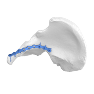 Placa De Bloqueo Anatómica De La Línea Anterior Iliopúbica FAP
