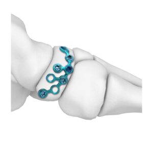 Placa De Bloqueo Navicular MT