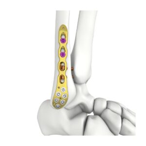 Placa De Bloqueo Del Peroné Lateral Distal Itval