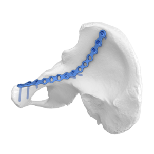 Placa De Bloqueo Anatómica Para Columna Anterior Iliopúbica FAP
