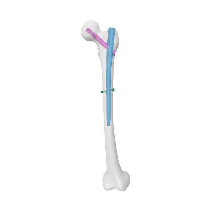 Prótesis de rodilla