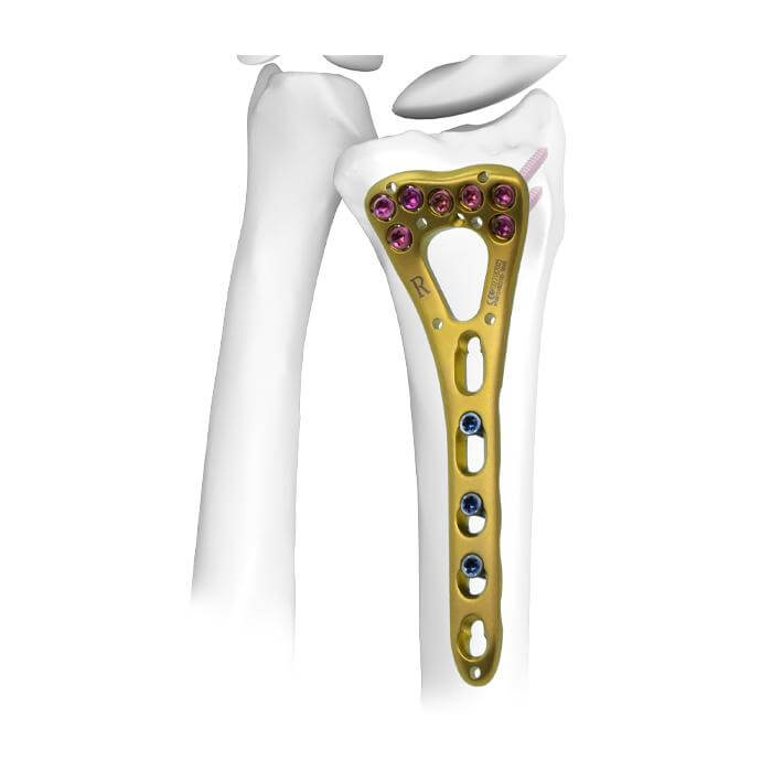 Prótesis de rodilla