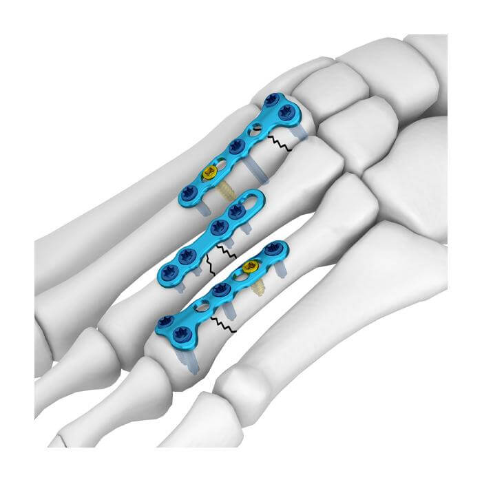Prótesis de rodilla